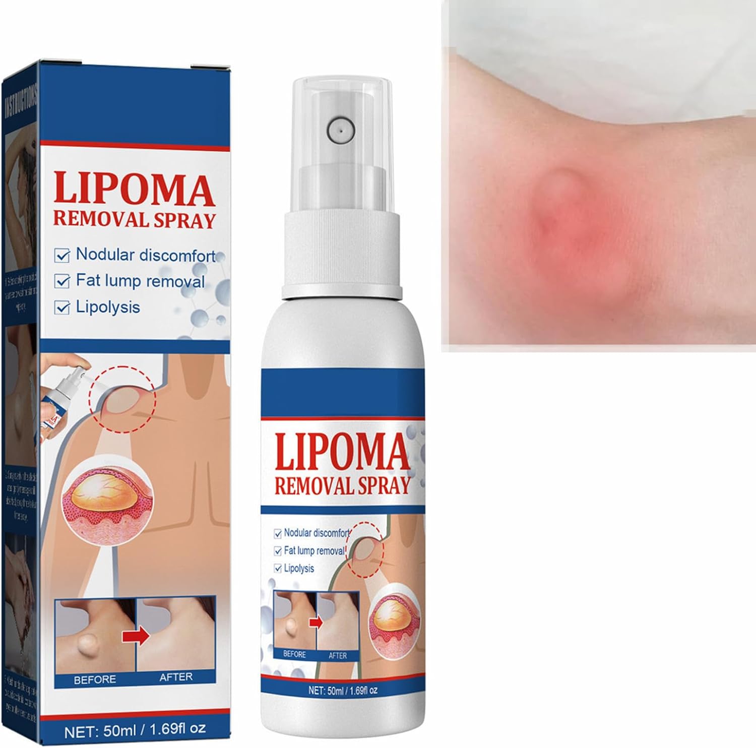 LIPOMA REMOVAL SPRAY ~লিপোমা রিমোভাল স্প্রে(১ পিস)